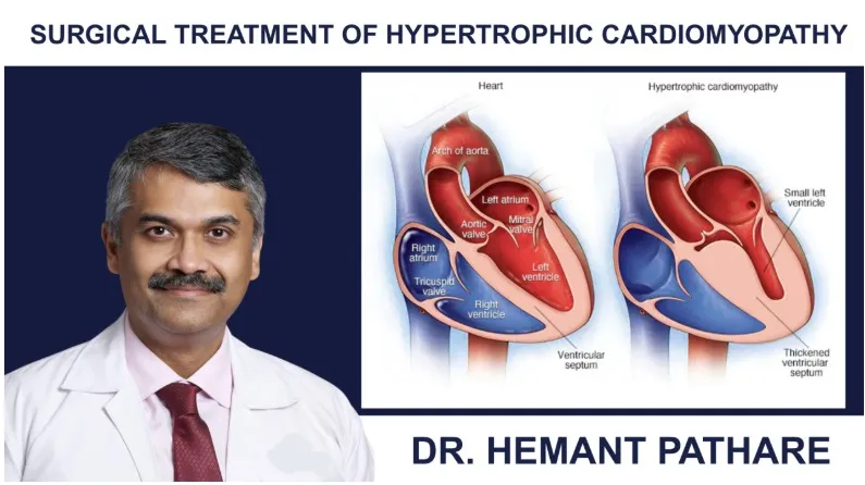 Surgical Treatment of Hypertrophic Cardiomyopathy