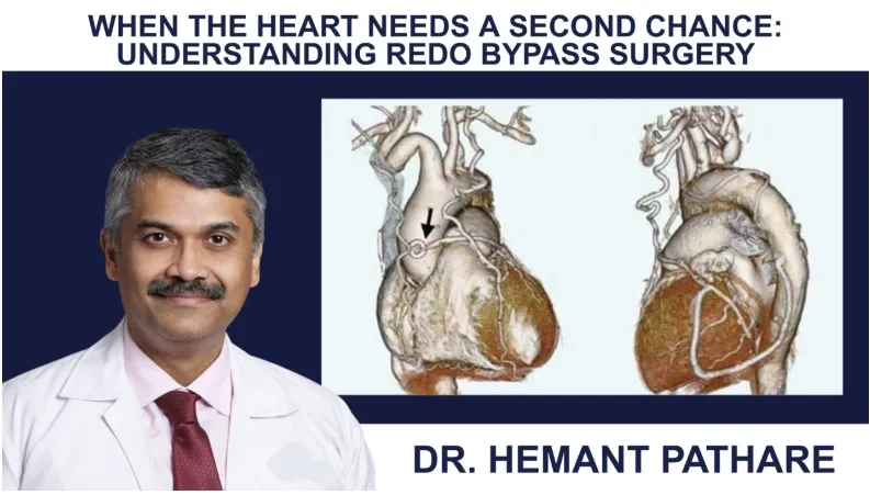 When the Heart Needs a Second Chance: Understanding Redo Bypass Surgery